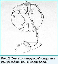 Диакарб при гидроцефалии у взрослых схема лечения